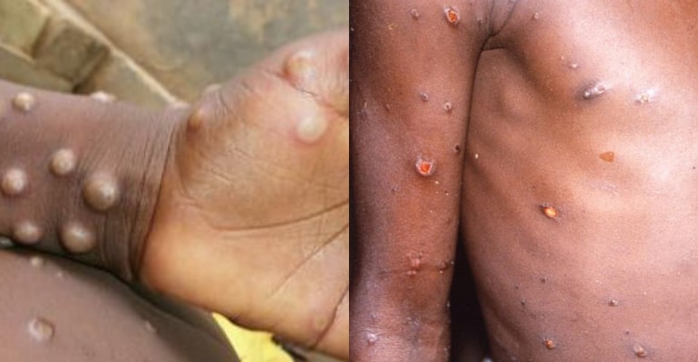 monkeypox-philippines-what-you-need-to-know